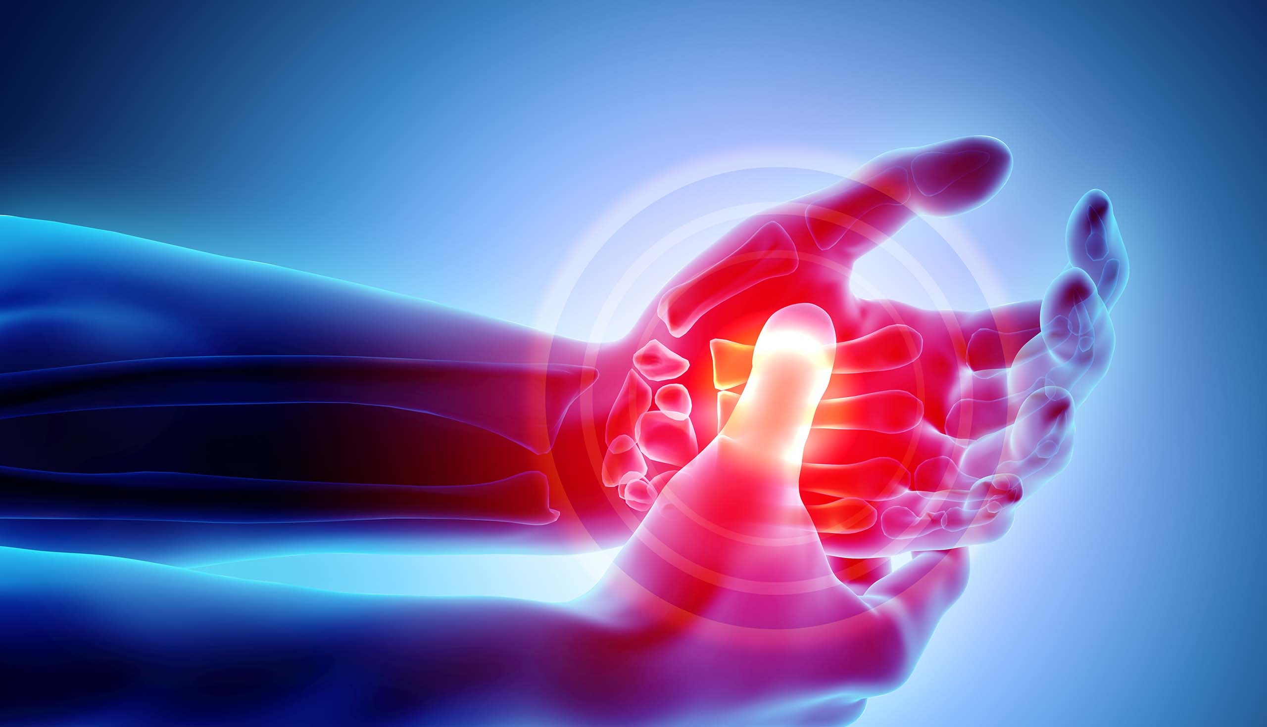 Arthritis of the hand illustration